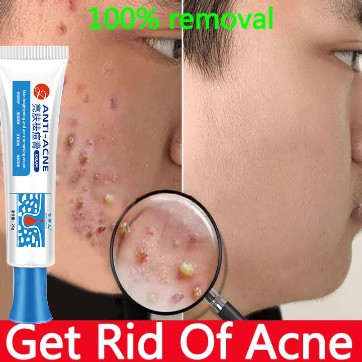 Effective Eliminate Acne Whitening Cream gentle remove pimple