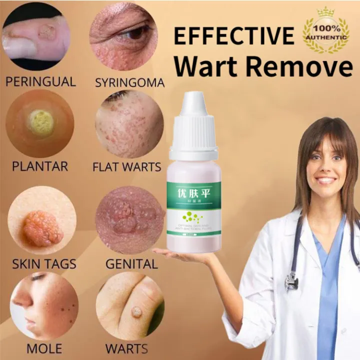 Wart Remover Cream Tag Solution Skin Tag Mole Mole Removal Mole Warts ...