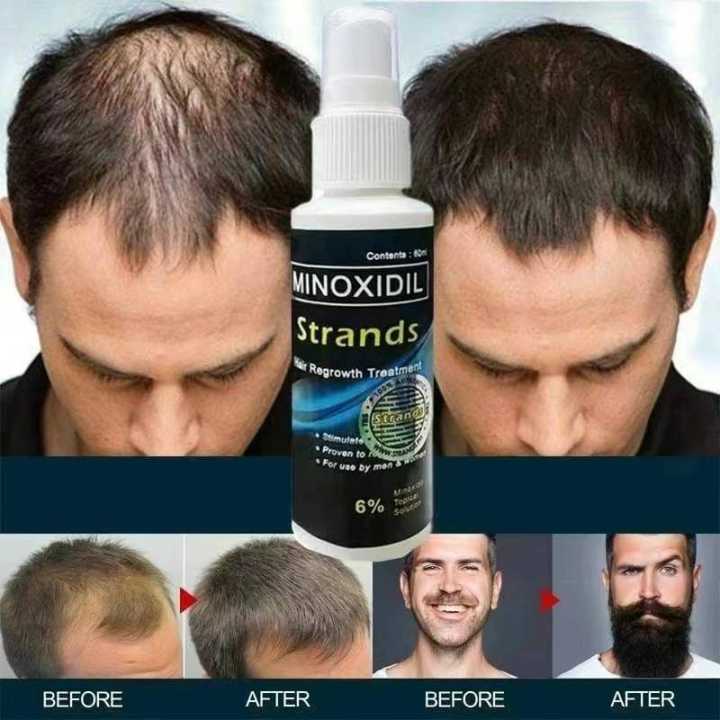 Minoxidil Strands Hair Spray Regrowth Treatment 6% Original Topical ...