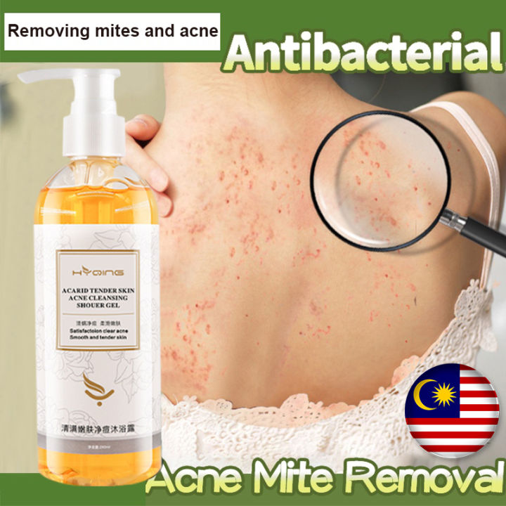 Acne body wash ubat jerawat badan Whitening Shower Gel Niacinamide
