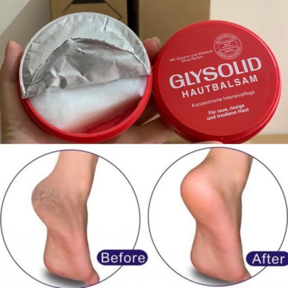 Glysolid Hautbalsam 100ml Kem dưỡng ẩm chăm sóc bàn chân cho gót chân bị nứt khô, Đức | Lazada.vn
