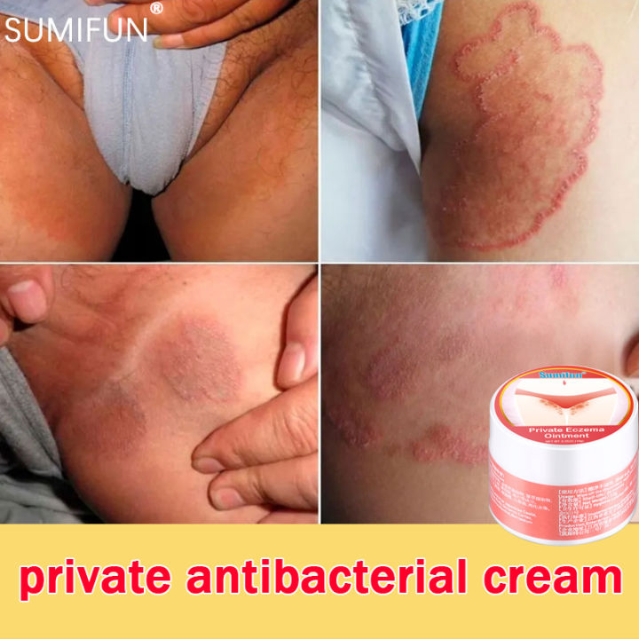 Itchy cream Antibacterial Ointment vaginal itch cream anti itch cream ...