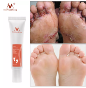MeiYanQiong Anti-fungal Infection Foot Anti-inflammatory Relieve Foot Itching Herb Beriberi Treatment Cream