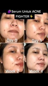 [COD]  SERUM PEMBASMI JERAWAT CEPAT BPOM  LACOCO GRAFE FRUIT