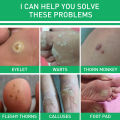 Jaysuing Warts Remove Liquid Smooth Skin Gentle Foot Care Ready Stock Wholesale. 