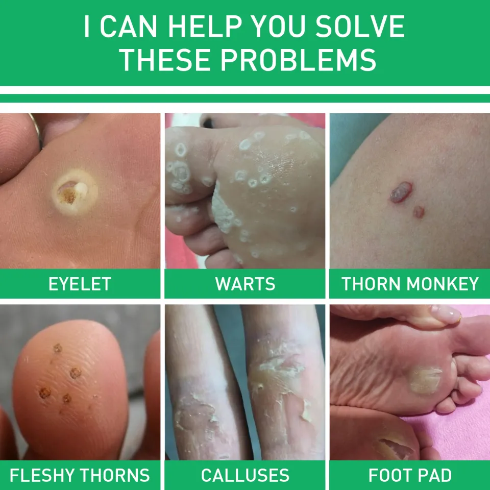 Jaysuing Effectively Remove Foot Corn Care Cream Remove Foot