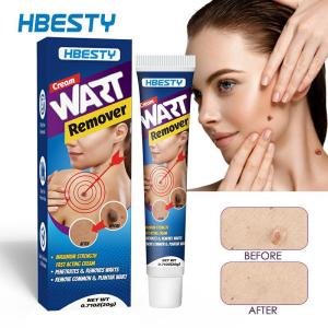 Wart removal Ointment Warts Remover Cream Skin tag removal  ubat buang kutil ketuat tahi lalat Warts Skin Tag cream to hard skin wart Corn Warts calluses foot Corns Meat Thorn Antibacterial