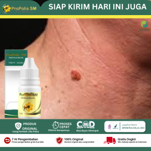 Obat Penghilang Kutil Obat Kutil Mata Ikan Kutil Kelamin Daging Tumbuh Kelenjar Getah Bening Papiloma Skin Tag Atasi dengan Propolis SM Brazilian With Nano Technology Asli 100% Original