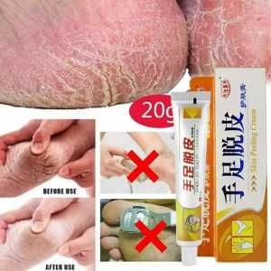Salep Kulit Telapak Kaki Tangan Pecah Pecah Peeling Skin Cream