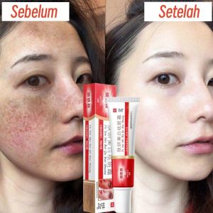 100%Effective Freckle Cream penghilang flek hitam whitening Krim anti bintik dan pemutih 20g cream melasma flek hitam ori Efektif Menghilangkan bintik hitam bekas jerawat