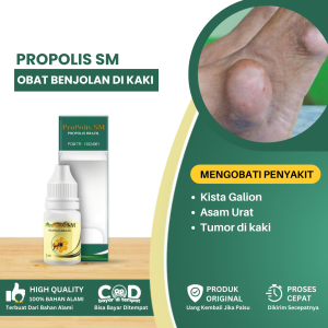 Obat Benjolan Di Kaki Penghilang Kista Galion Di Kaki Obat Asam Urat Obat Radang Sendi Benjolan Pada Sendi Kaki Obat Bunion - Propolis Sm
