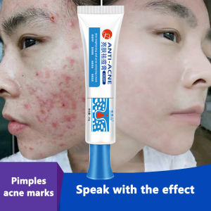 Krim Penghilang Jerawat salep jerawatanti bakteri krim Acne Treatment Skin Acne Oil Control Oil Shrink Pores/krim jerawat paling ampuh/Cream penghilang jerawat dan bekas jerawat/Krim penghilang jerawat merah/krim jerawat dan berminyak