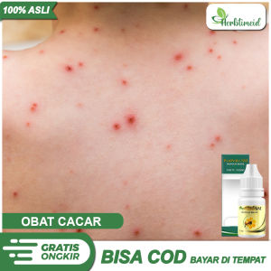 Obat Cacar Bintik Bintik Merah Berair Cacar Berair Campak Cacar Api Bernanah Obat Oles Cacar Air Cacar Monyet Campak Dengan Herbal Propolis Sm