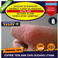 Obat Kutu Air Di Telapak Tangan Alami, Obat Kutu Air Di Kuku Tangan, Obat Kutu Air Di Tangan Secara Alami, Obat Herbal Untuk Kutu Air Di Tangan, Obat Gatal Kutu Air Di Tangan, Obat Untuk Kutu Air Bernanah Di Tangan, Dengan Propolis SM Solusi Herbal Alami. 