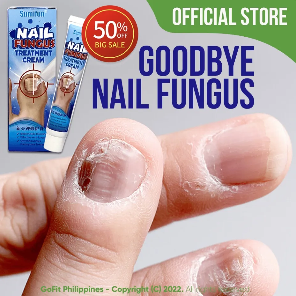 Sumifun 20g Nail Fungus Treatments Cream Anti Fungal Foot Toe Nails Repair  Anti-infection Onychomycosis Paronychia Ointment - Plaster - AliExpress