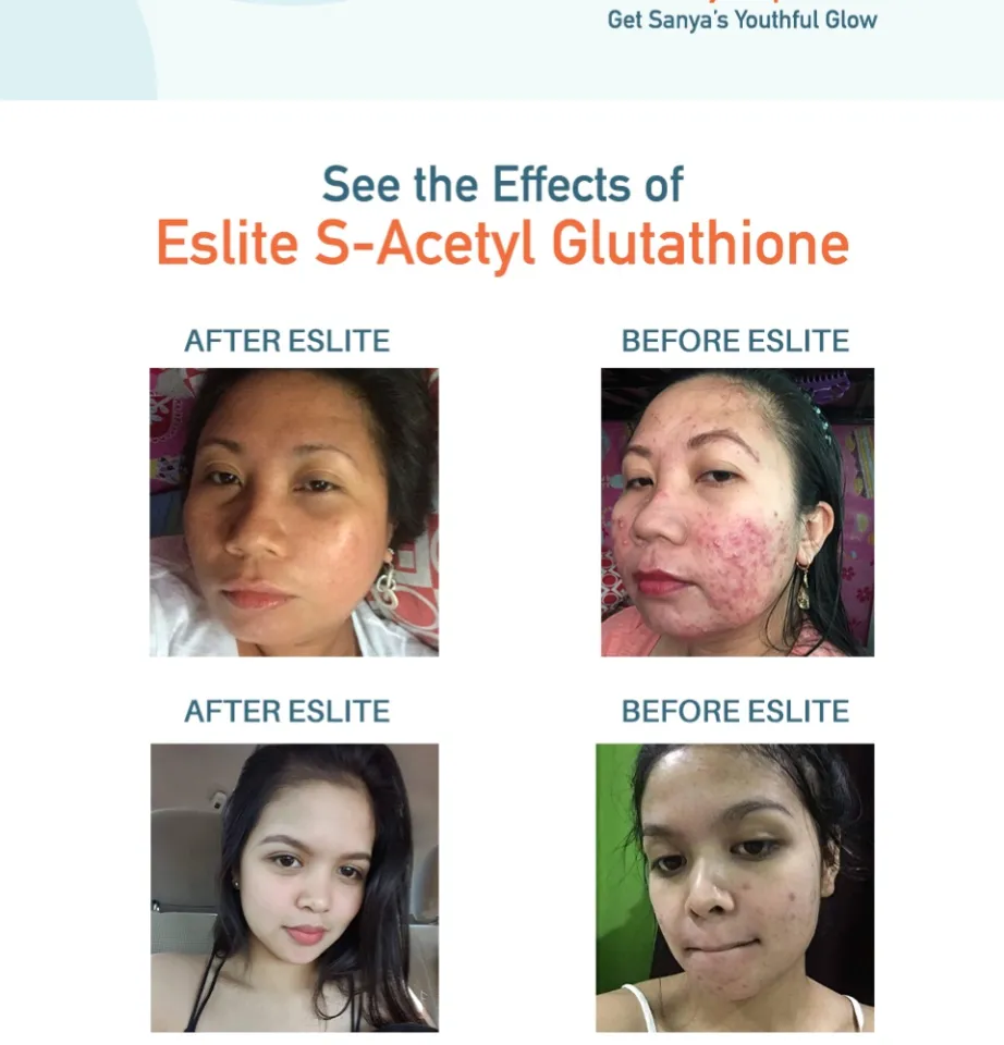 selenium supplementation and glutathione peroxidase Role of Selenium-Dependent Peroxidases (Seleno-GPxs) in Radio-Modulation: Lessons for Radiation Oncology | Biological Trace Element Research Size:30 Caps 325mg 5 Amino 1Mq Kapsułki Concern:Sun Protection