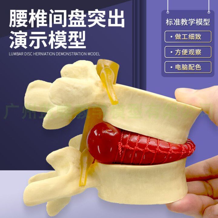 Medical Human Lumbar Disc Compression Demonstration Model Human Spine ...
