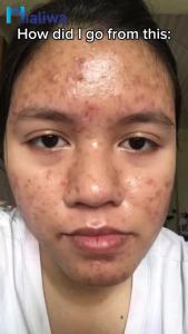 Skin Magical Rejuvenating Set 3 Pampaputi Whitening Exfoliating Moisturizing Beauty Skin Care Kojic Soap Facial Toner Night Cream Sunblock Sunscreen Pimple Acne Pores Blackheads Pekas Melasma Scar Dark Spot Anti Aging Hydrating Moisturizer For Men & Women