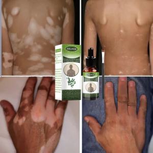 (100% hiệu quả) Tinh chất tẩy sạch bạch biến EELHOE loại bỏ vẩy nến nấm da bạch biến lang ben hắc lào  làm đều màu da tái tạo phục hồi da nhanh chóng Dưỡng Ẩm Cho Mọi Loại Da - Lazada