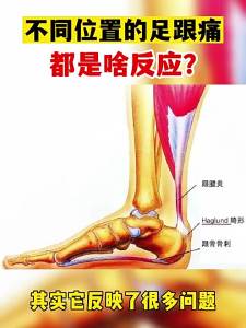 足跟痛贴膏 (升级款）Patches Heel Foot Pain Foot foot heel pain Foot pain Achilles tenditis Fasciitis Bone Bone Heel Pain Special effect paste Demolstation