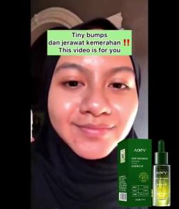 Serum Anti-Acne & Serum Bekas Jerawat Acneno 30ml: Krim Penghilang Jerawat dan Flek Hitam
