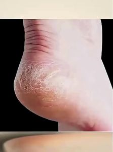 BAKULI | Remove Dead Skin and Corn Foot Care Tool